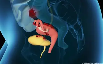 Endometriose Endometriose