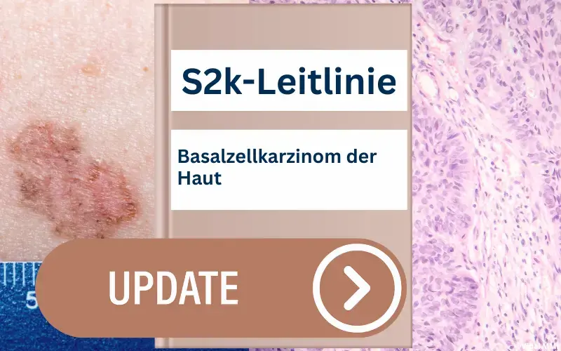 S2k-Leitlinie Basalzellkarzinom der Haut