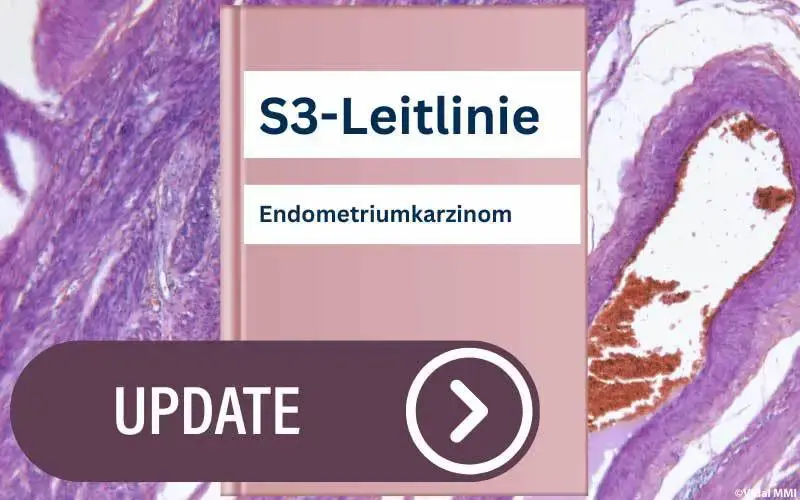 S3-Endometriumkarzinom