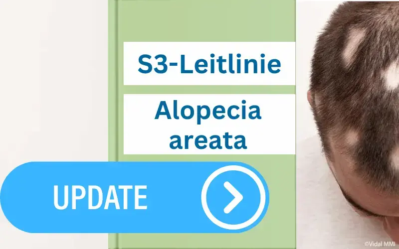 S3-Leitlinie-Alopecia-areata