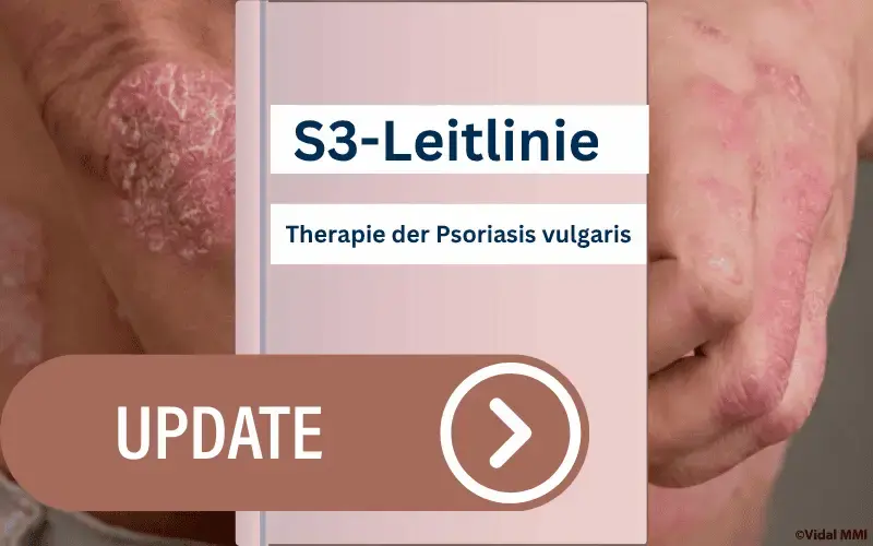 S3-Leitlinie Psoriasis vulgaris