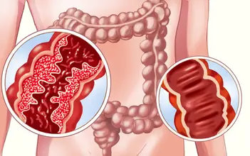 LeitMed Campus Morbus Crohn LeitMed Campus Morbus Crohn