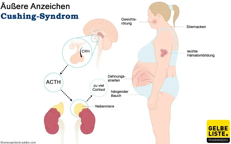 Cushing-Syndrom