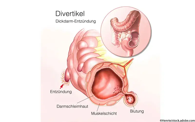 Divertikel