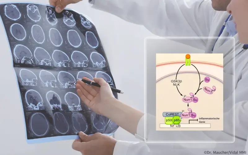 Gehirn Nurr1 Multiple Sklerose