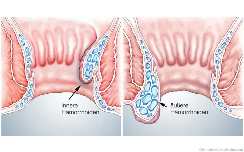 Hämorrhoiden