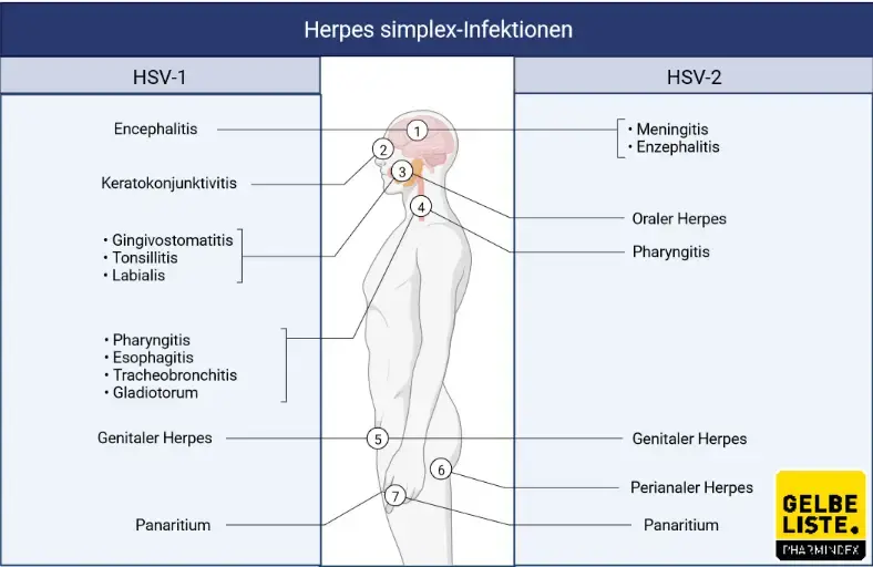 Herpes simplex Infektionen