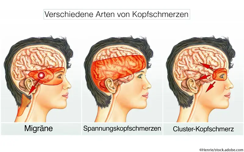 Kopfschmerzarten