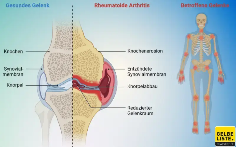 Rheumatoide Arthritis betroffene Gelenke