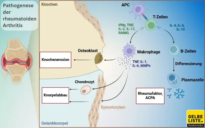 Rheumatoide Arthritis