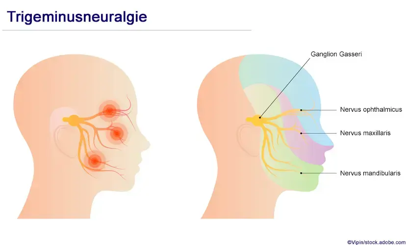 Trigeminusneuralgie