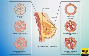 Brustkrebs Brustkrebs