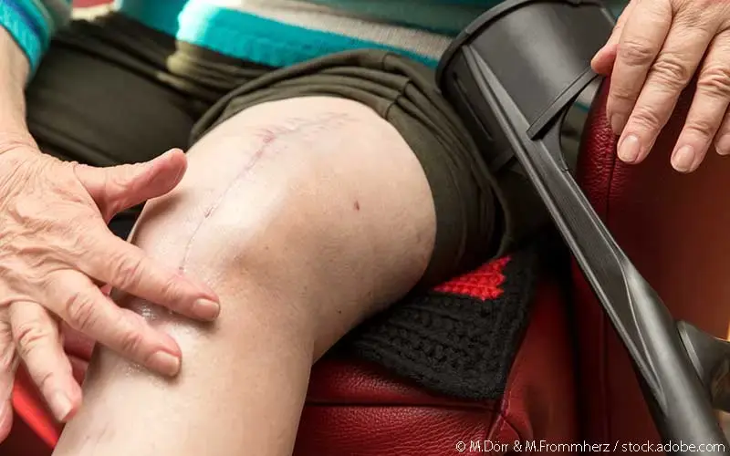 Frau mit Knie-OP-Narbe