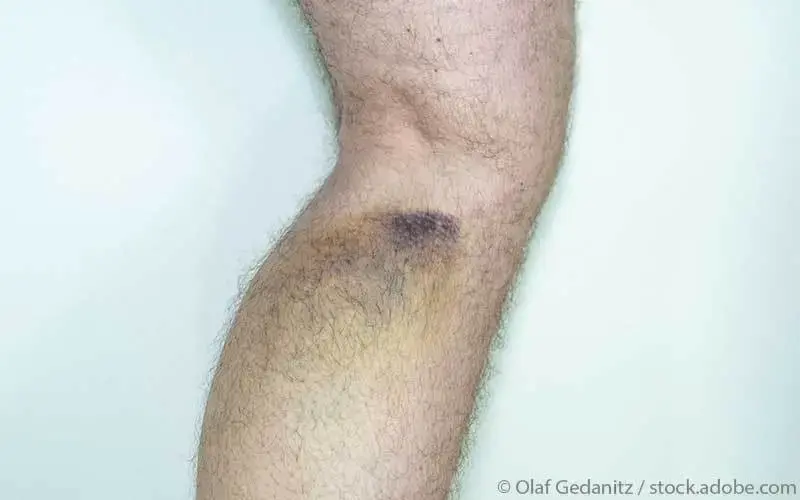 Muskelfaserriss-mit-haematom