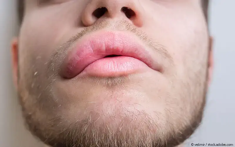 Patient geschwollene Oberlippe
