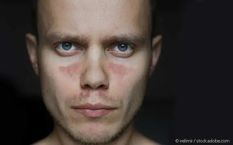 Patient Lupus erythematodes