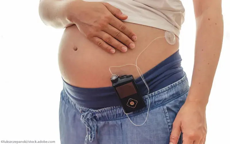 Schwangere mit Insulinpumpe