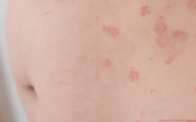 Schwangere Psoriasis