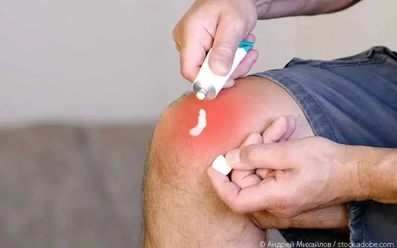 Topische Anwendung Schmerzsalbe