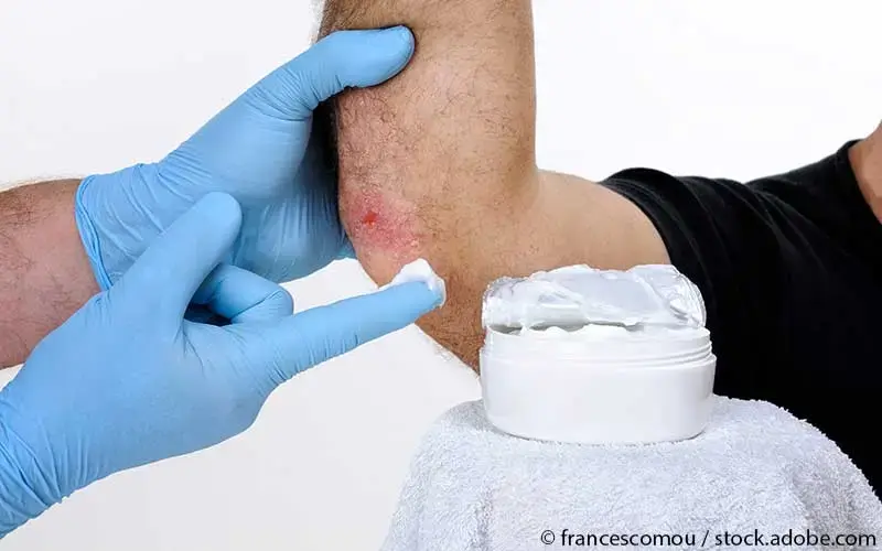 Creme auftragen Psoriasis
