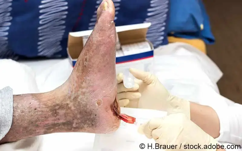 Diabetischer Fuss_Behandlung
