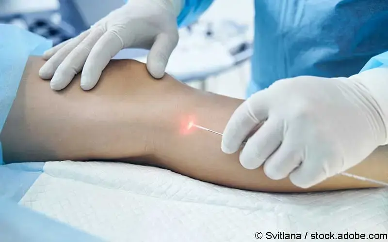 Endovenöse Lasertherapie