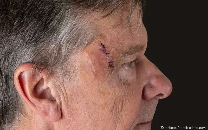 Hautkrebs Operationsnarbe