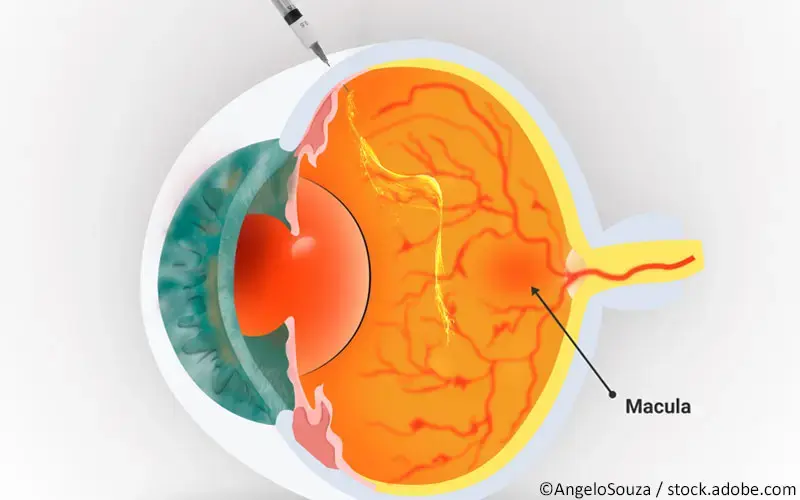 Intravitreale Injektion