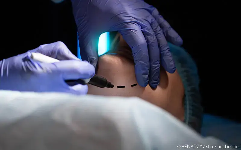 Liposuktion Kinn