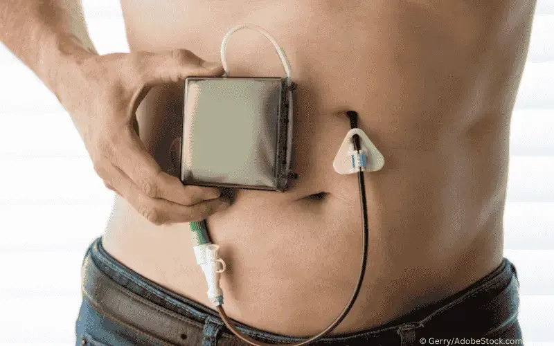 Perkutane Endoskopische Gastrostomie