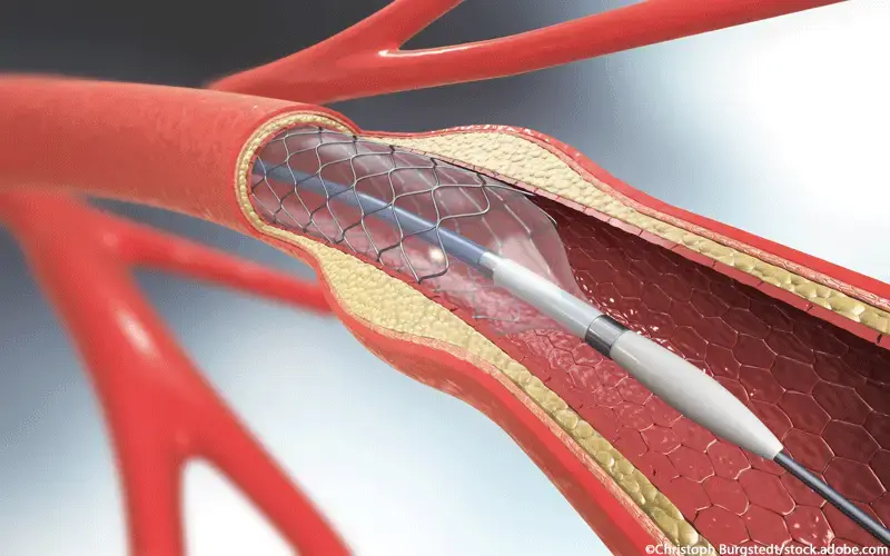 Stent-Platzierung