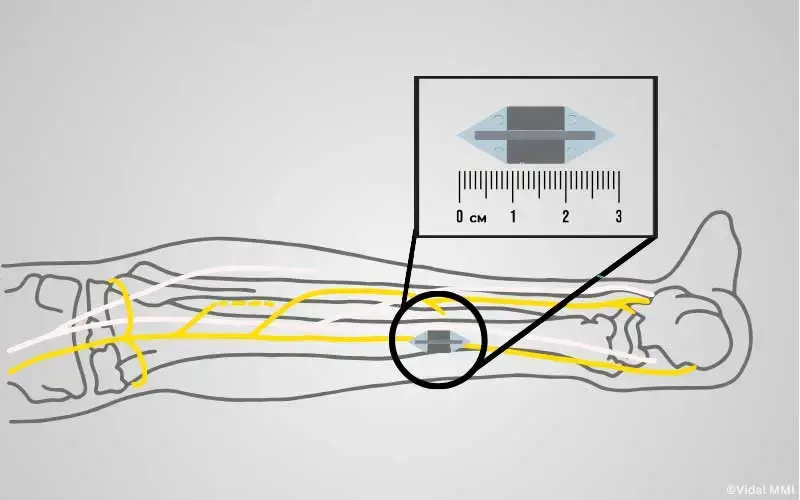 Tibialnerv Stimulation