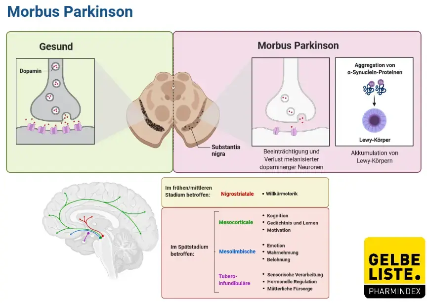Parkinson