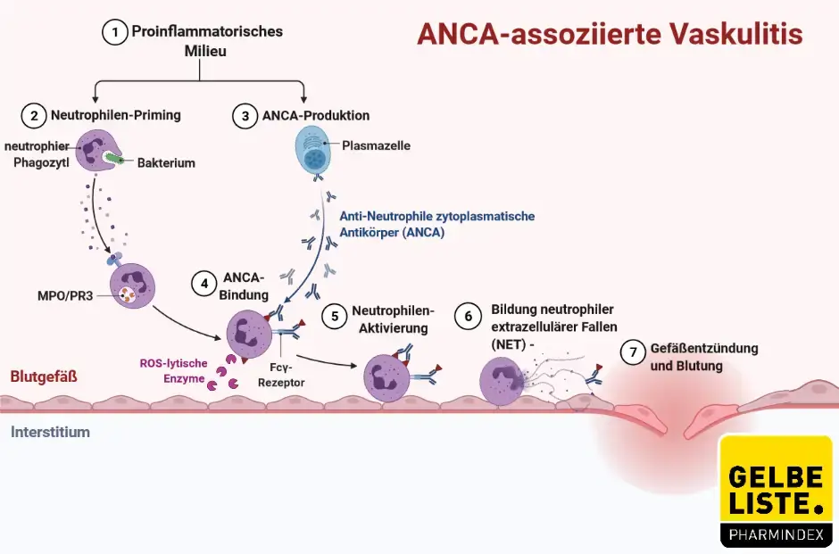 Anca assoziierte Vaskulitis Anca assoziierte Vaskulitis